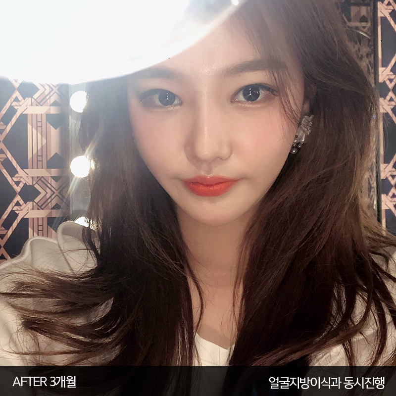 얼굴지흡붓기 김형진베이직은 달라요 관련 이미지 7