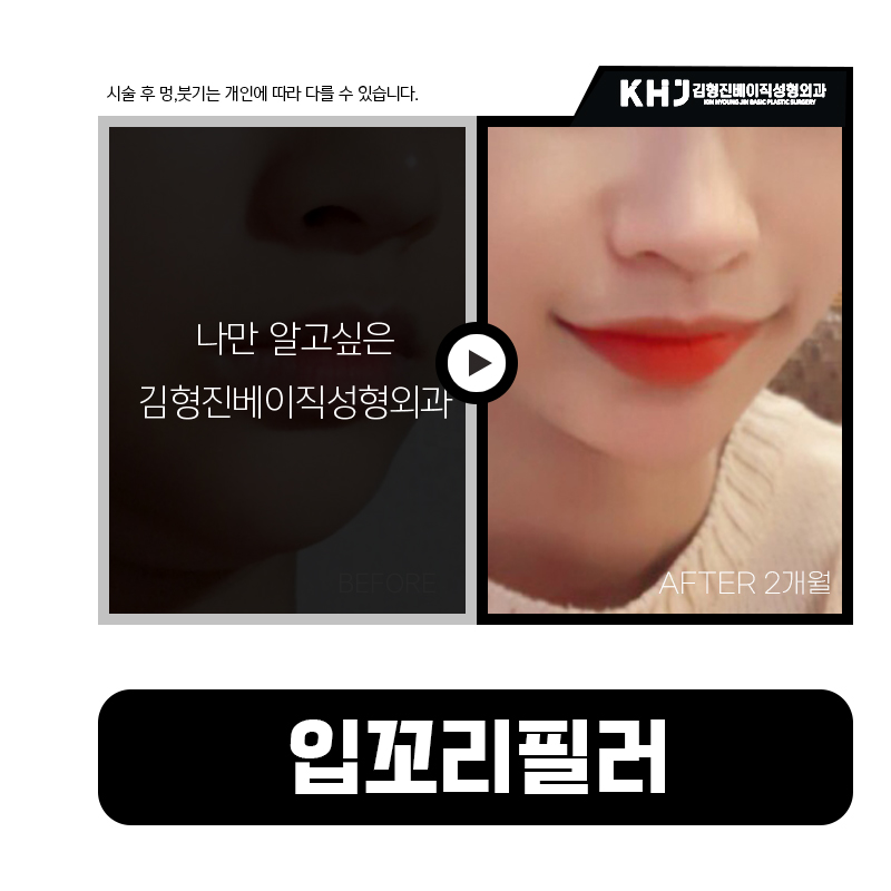 입꼬리비대칭? 입꼬리필러로 생기 있는 미소 완성! 관련 이미지 6
