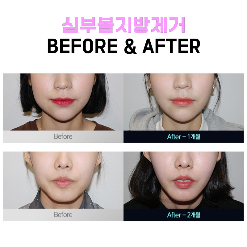 심부볼없애는법, 얼굴형이 매끄럽게 변했어요 관련 이미지 5