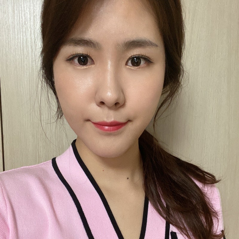 Why I Never Had to Go Back After Lower Eyelid Fat Removal image 3