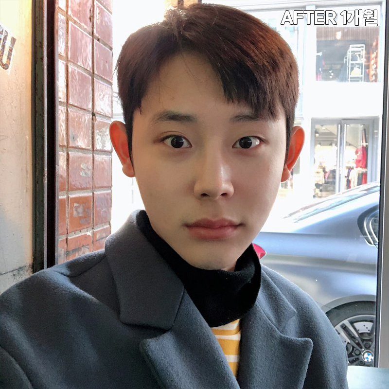 남자심부볼제거? 당연히 가능하죠! 관련 이미지 6