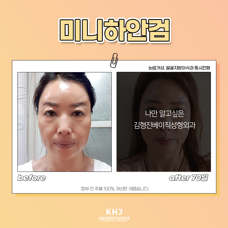 중년눈밑수술 더 이상 미루지 마세요! 관련 이미지 4