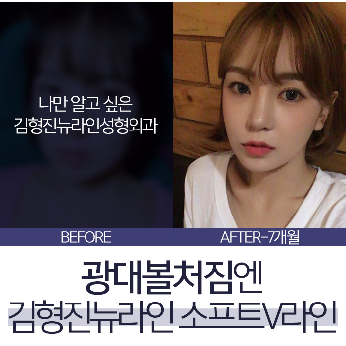 광대볼처짐 이렇게 해야 되요! 관련 이미지 3