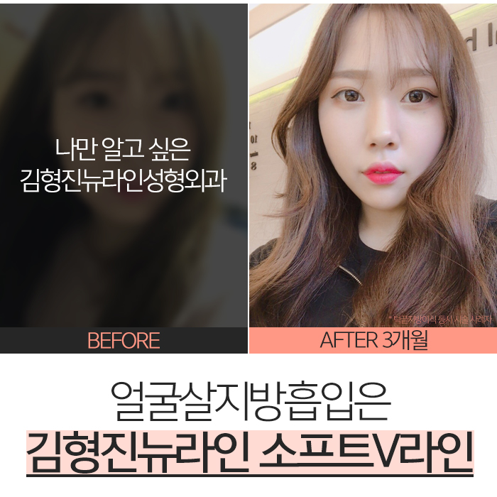 얼굴살지방흡입 하려면 이걸 해야지! 관련 이미지 5