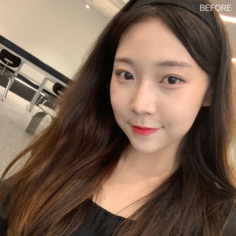심부볼제거잘하는곳은? 바로 김형진베이직이죠! 관련 이미지 2