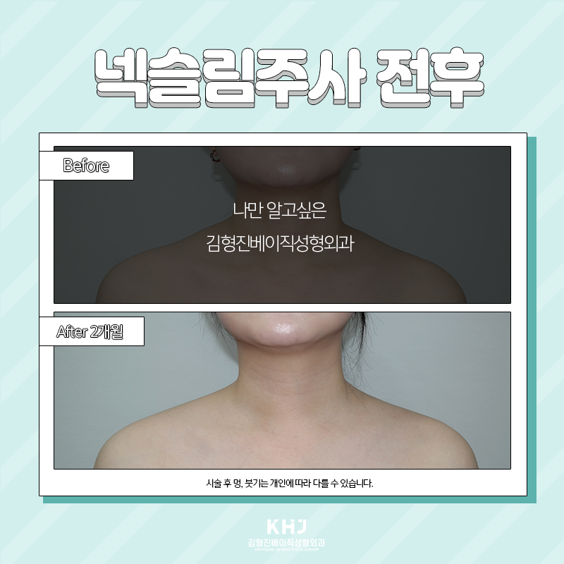 넥슬림주사전후 확인하고 가세요~! 관련 이미지 6