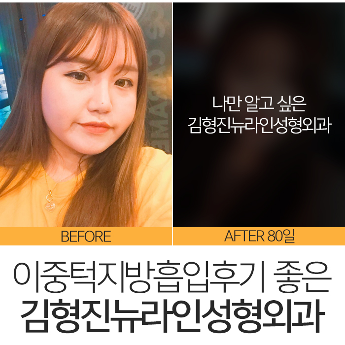 이중턱지방흡입후기 솔직하게 관련 이미지 8