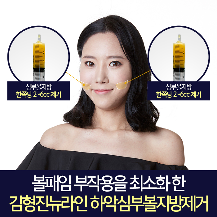 하악심부볼지방제거수술 부작용을 잡다 관련 이미지 5