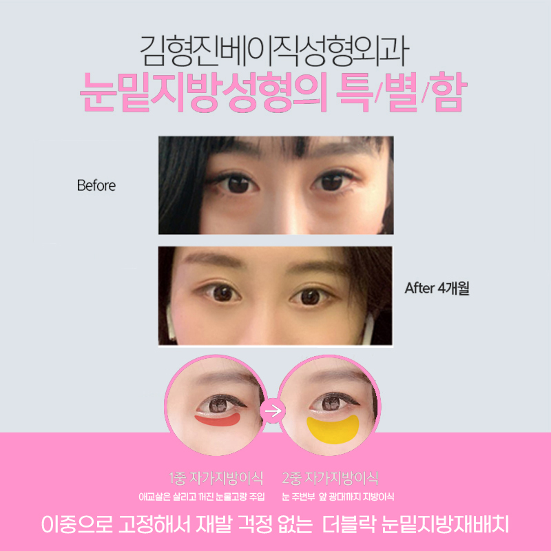 지저분한 눈 밑? 재발 걱정 없는 압구정눈밑지방제거로 해결! 관련 이미지 5