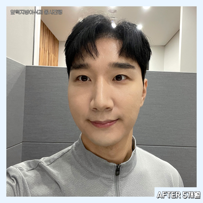 남자심부볼제거 가능하냐구요? 당연하죠! 관련 이미지 6