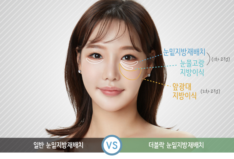 눈밑지방재배치레이저 티 안나게 해야죠 관련 이미지 2
