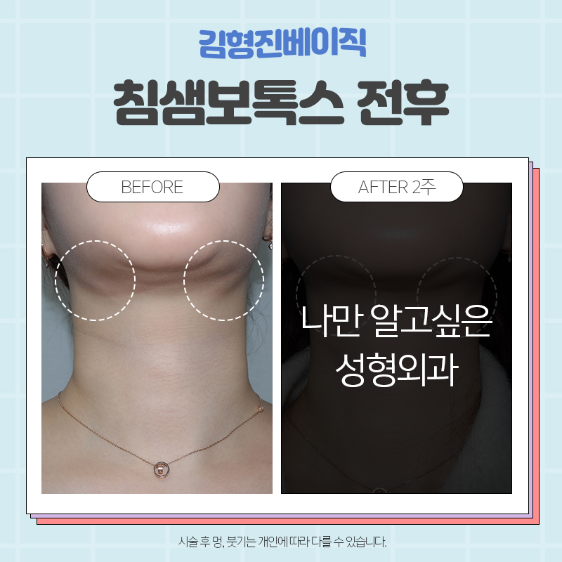 침샘보톡스전후 확실한곳, 김형진베이직 관련 이미지 2