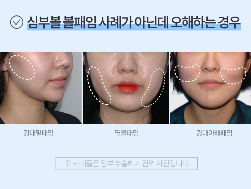 심부볼패임 너무 걱정된다구요? 관련 이미지 6