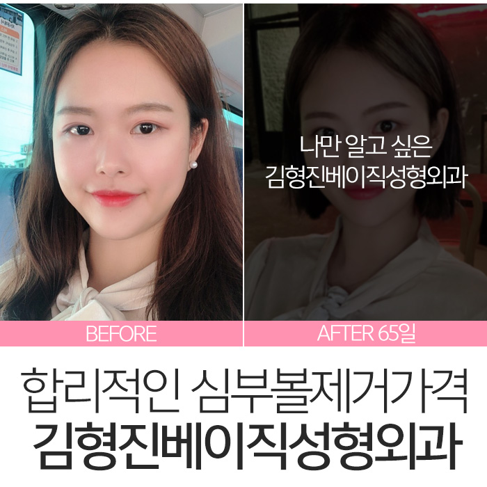 심부볼지방제거가격 싼 곳 보다는 실력이 중요! 관련 이미지 8