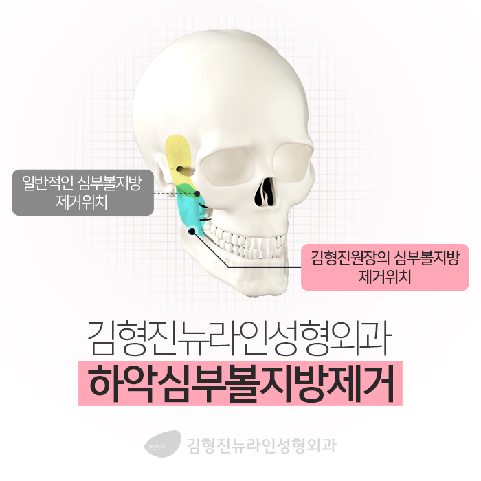 하악심부볼지방제거 안전과 부작용을 생각한다면 관련 이미지 4