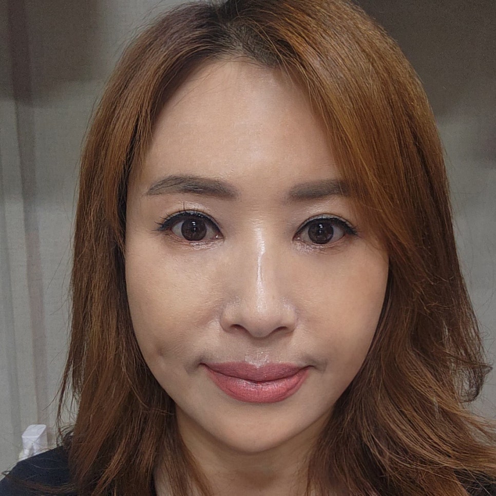 효도성형추천 변화가 확실한 김형진베이직의 미니하안검 관련 이미지 1