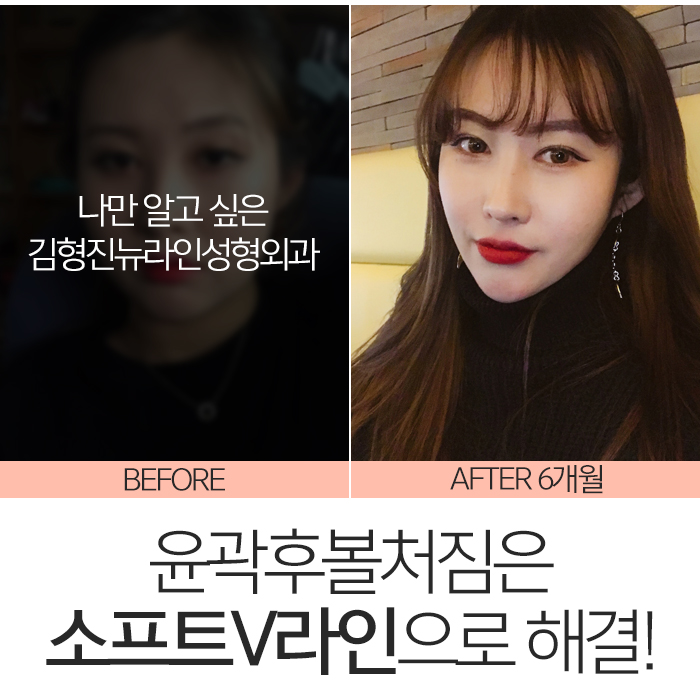 윤곽후볼처짐 해결하려면 관련 이미지 3
