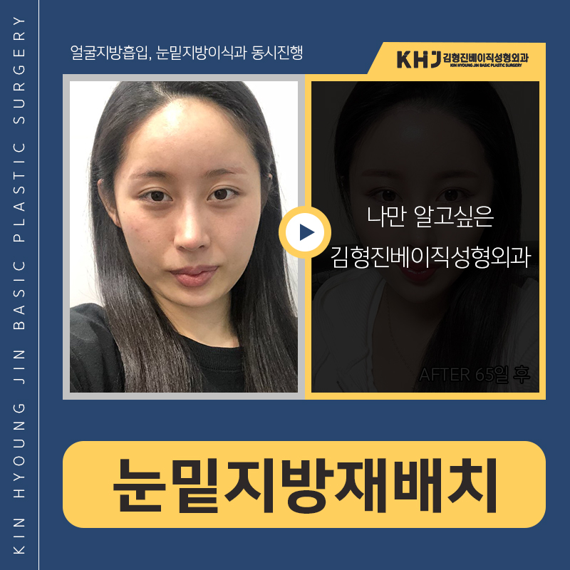 눈밑지방재배치재수술 걱정마세요 관련 이미지 6