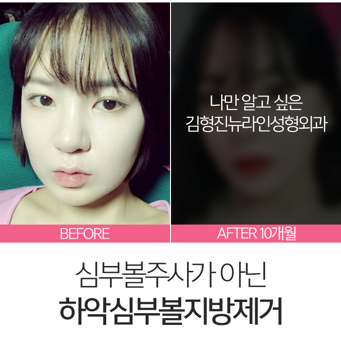 심부볼주사 이걸론 절대 못 빼요 관련 이미지 8