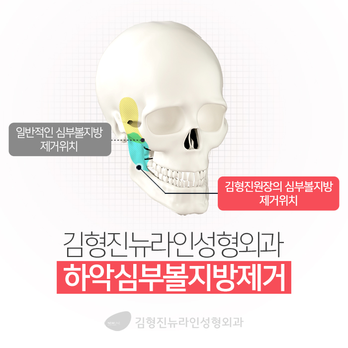 심부볼가격 아직도 싼 곳만 찾아요? 관련 이미지 4