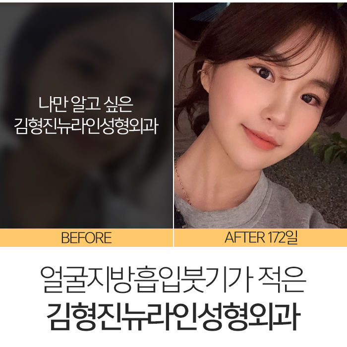 얼굴지방흡입붓기 솔직히 없을 순 없어요 관련 이미지 2