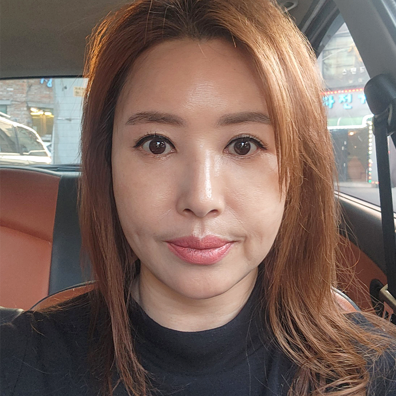 미니하안검흉터 걱정할 필요 없어요 관련 이미지 1