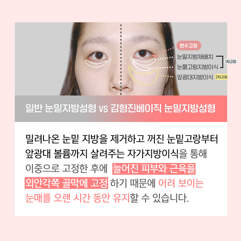 미니하안검흉터 걱정하지마세요! 관련 이미지 2