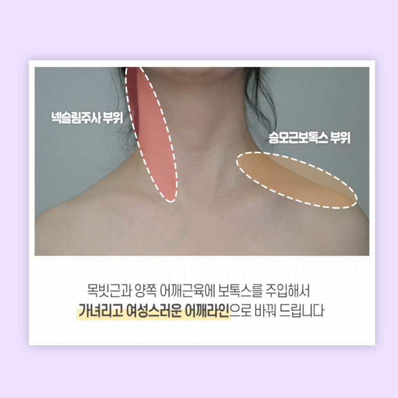 넥슬림주사로 이쁜 목라인 만들기 관련 이미지 6