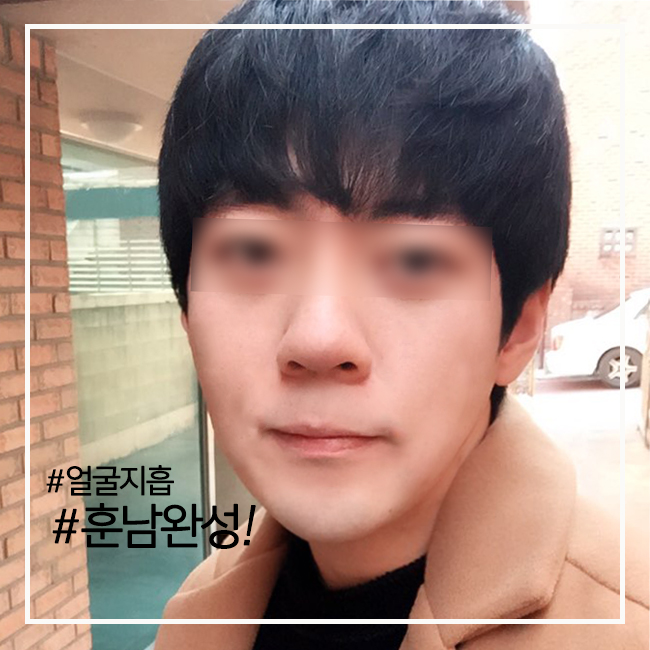 남자얼굴축소 뼈를 깎지 않고 가능! 관련 이미지 3