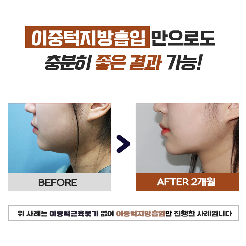 입소문 난 이중턱제거잘하는곳은 믿고 가요! 관련 이미지 5
