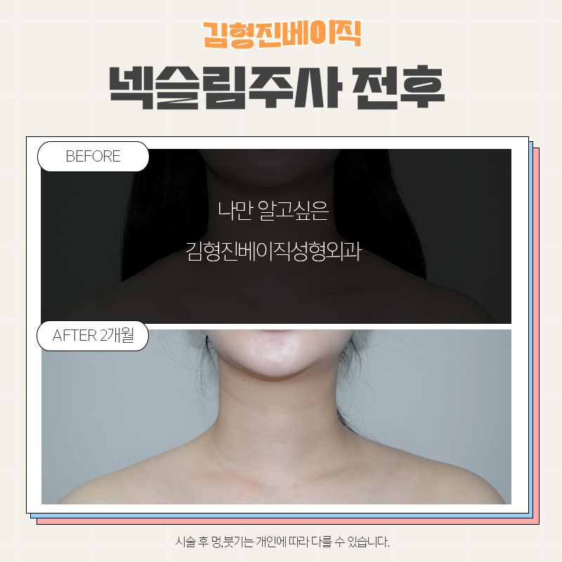목보톡스후기 김형진베이직만 한 곳 없죠 관련 이미지 3