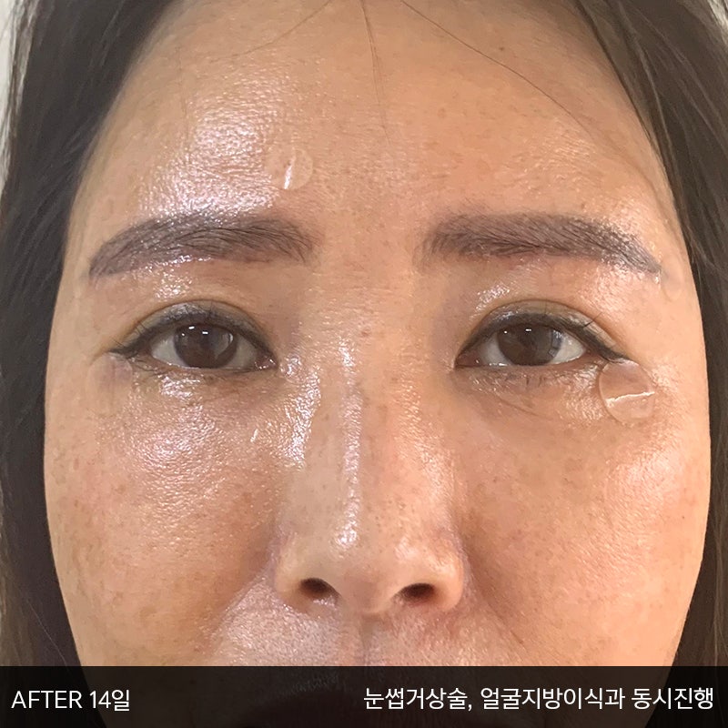 중년눈밑지방수술 아직 모르신다면 관련 이미지 5