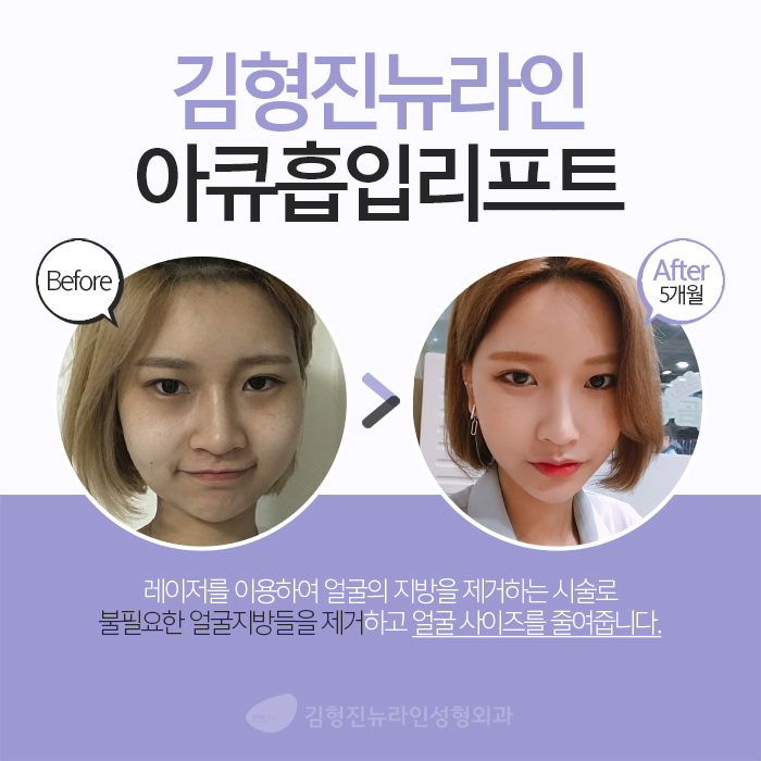 아큐스컬프부작용 걱정된다면 관련 이미지 4