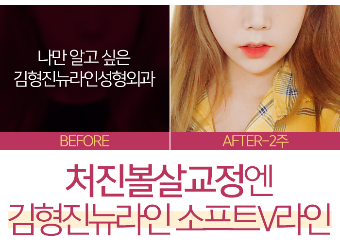 처진볼살교정 하고싶다면 관련 이미지 5