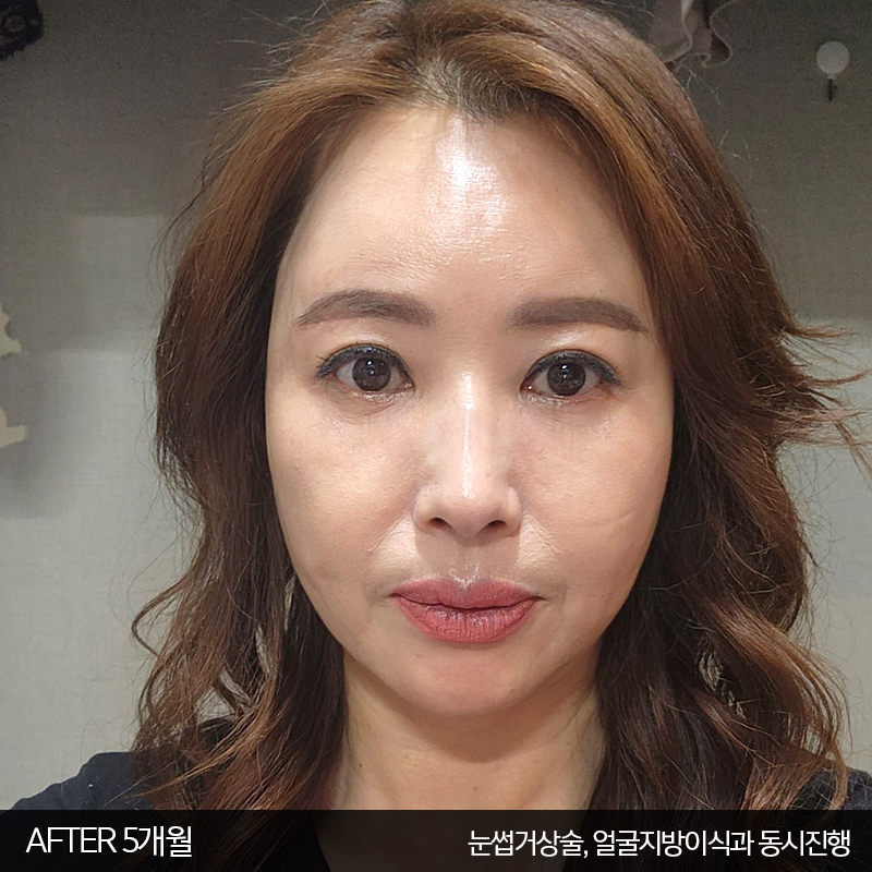 미니하안검수술방법 궁금하시죠? 관련 이미지 6