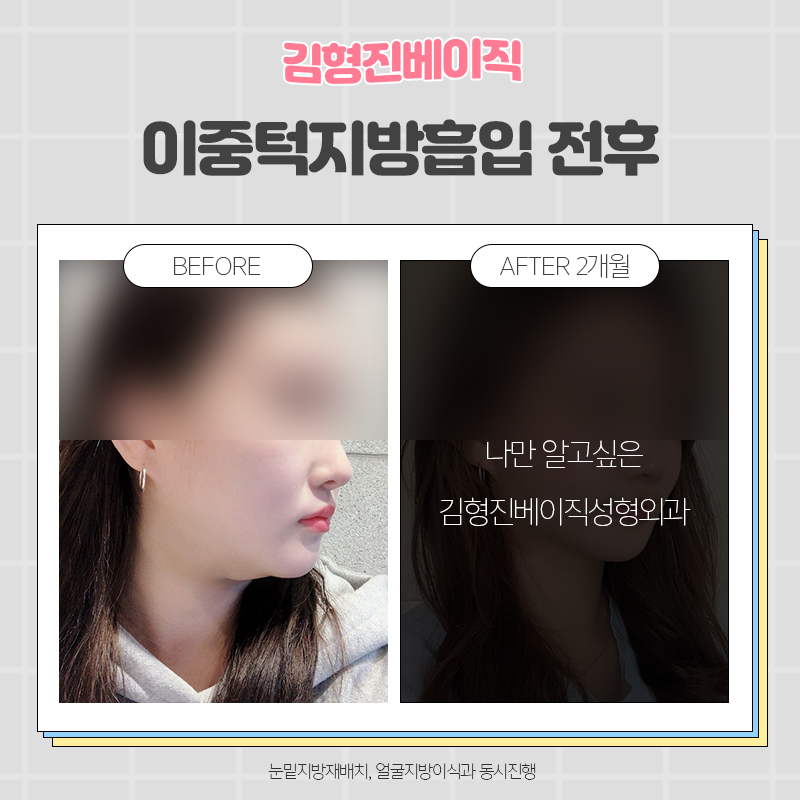 턱살흡입전후 궁금하다면 여기로! 관련 이미지 2