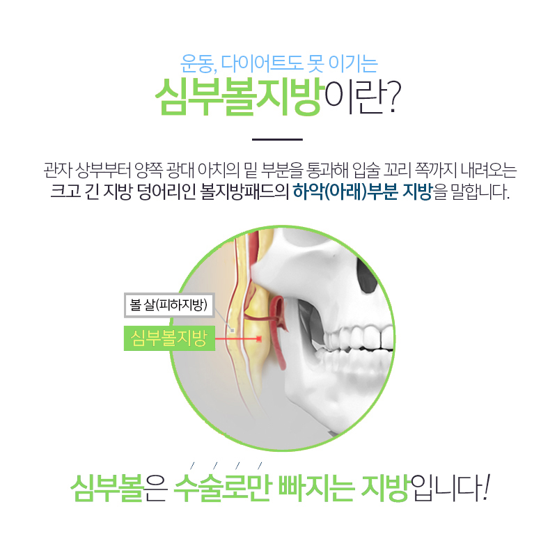 김형진베이직 얼굴지방흡입수술 변화 확실한 곳 관련 이미지 5
