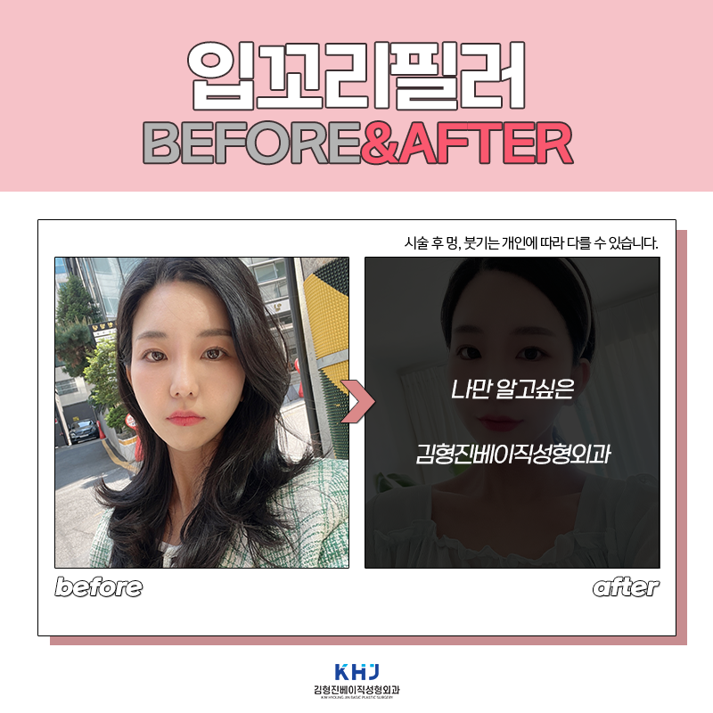 입꼬리필러전후 보고 가실래요? 관련 이미지 3