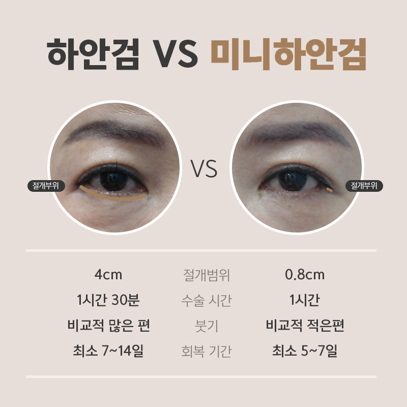 중년성형후기, 눈 밑이 조금만 달라져도 인상이 확 바뀌어요! 관련 이미지 4