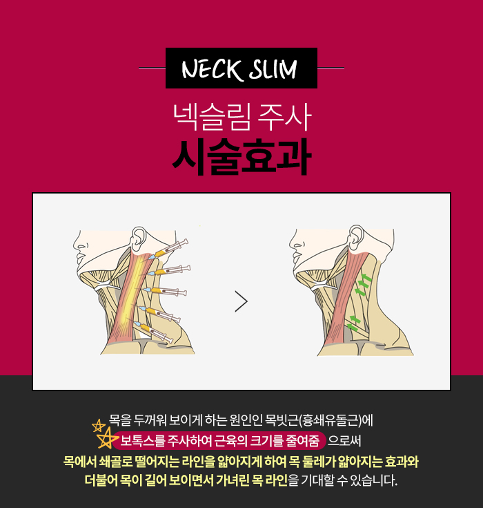 넥라인보톡스 진짜 해야 할때 (a.k.a 김형진베이직 넥슬림주사) 관련 이미지 5