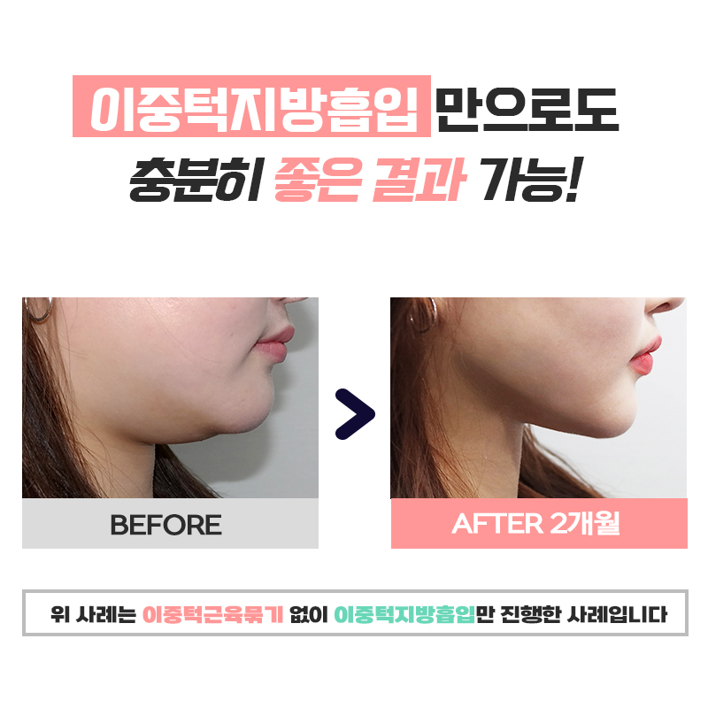 탄력까지 잡는 이중턱제거수술로 자신감 되찾았어요 관련 이미지 6