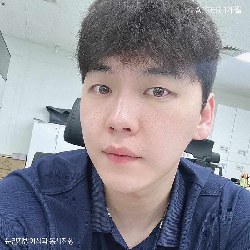 눈밑지방재배치잘하는병원 김형진베이직! 관련 이미지 3