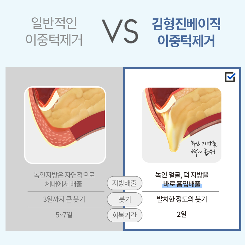 이중턱지방흡입처짐 걱정없어요! 관련 이미지 2