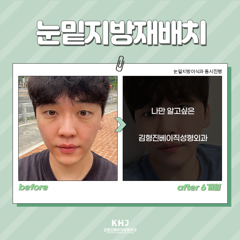 눈밑지방재배치유지력 오래가는 수술방법 찾으셨다면! 관련 이미지 5