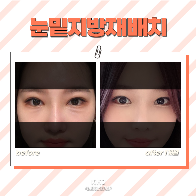 눈밑지방재배치후기 미묘한 차이가 인상을 바꿔요 관련 이미지 6