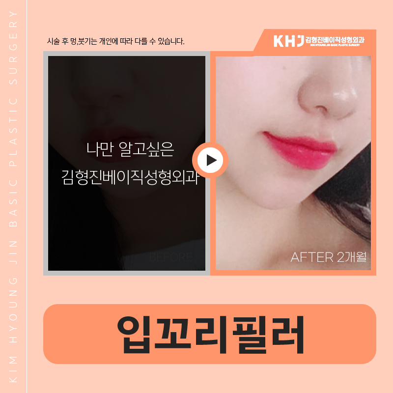 입꼬리필러시술로 자연스럽게 미소 띈 인상을 만들어요! 관련 이미지 7