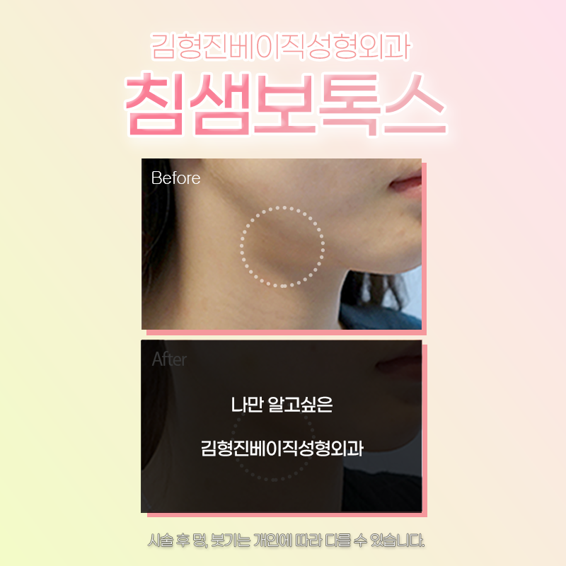 침샘보톡스효과 볼 수 있는 곳에서 하셔야죠 관련 이미지 5