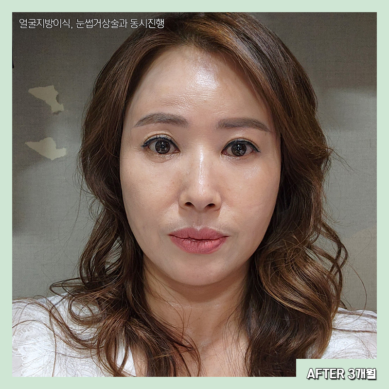 미니하안검수술 아직도 모르시나요? 관련 이미지 5