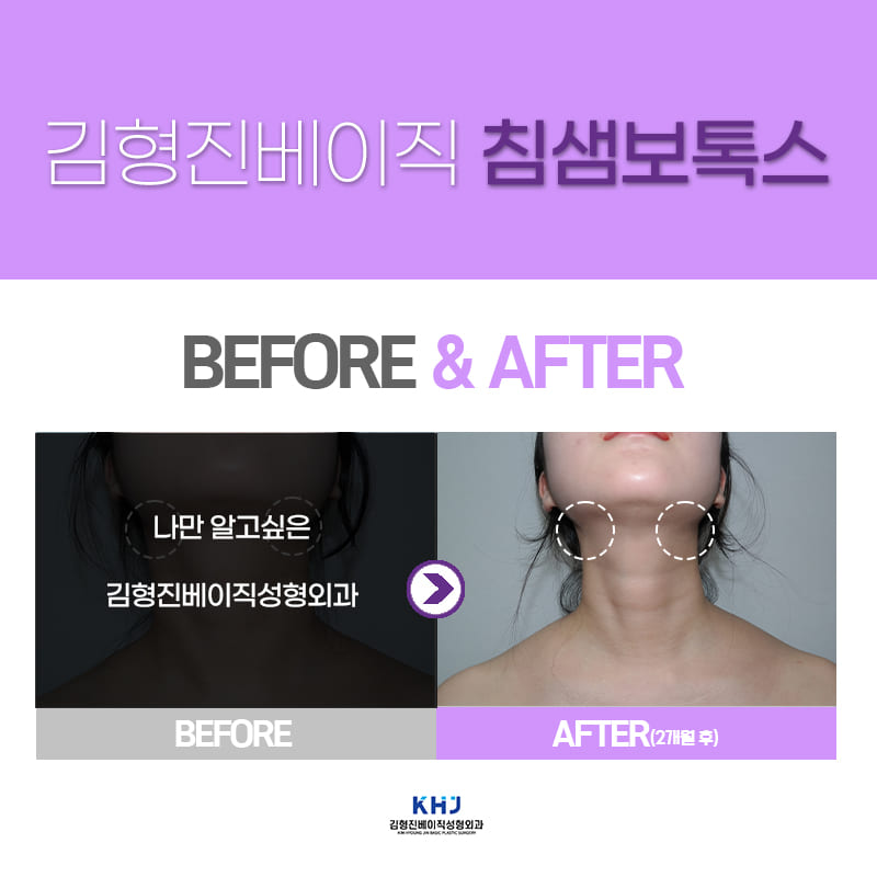 침샘보톡스잘하는곳에서 작은 얼굴 만들기 성공! 관련 이미지 6