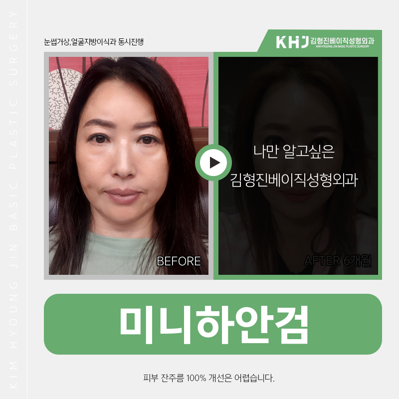 중년눈밑수술 김형진베이직에서 하셔야죠! 관련 이미지 2
